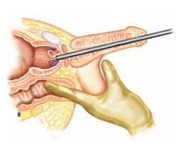 Cirugía para la incontinencia urinaria en hombres - urologia.med.ec