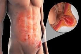 Imagen localización Hernia Inguinal
